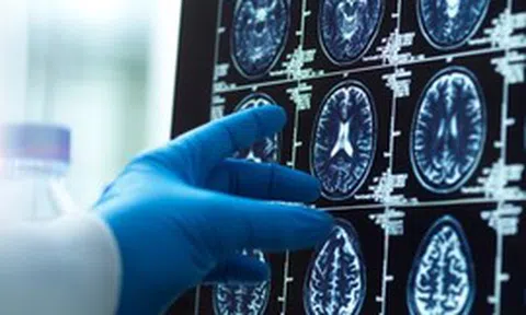 AI lần đầu hỗ trợ mổ não trực tiếp trên người: Cuộc thử nghiệm có thể thay đổi cách bác sĩ phẫu thuật